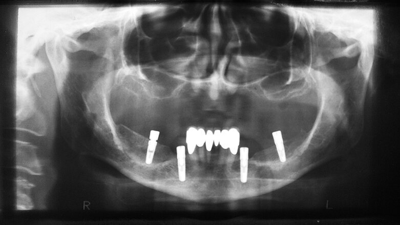 Restauration implantaire assistée par ordinateur chez des patients atteints d’une tumeur