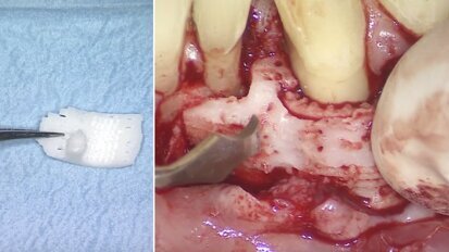 Дентална тъкан, отпечатана на 3D принтер: първият опит за лечение на пациент е неуспешен в дългосрочен план