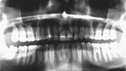 Fig. 2. Situación inicial, radiografía panorámica (2015).