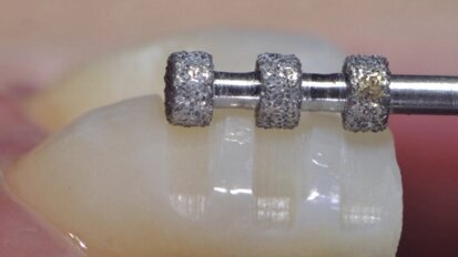 Estética y blanqueamiento dental en la era digital  (Capítulo 14)