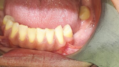 Śródkostna postać torbieli naskórkowej zlokalizowana w żuchwie – opis przypadku