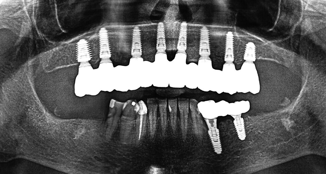 Fig. 5l: Panoramic radiograph verifying the fit of the restoration and direct sealing with no gaps.