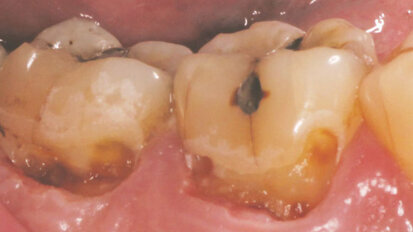 Anesthesia-free and drill-free deep decay removal