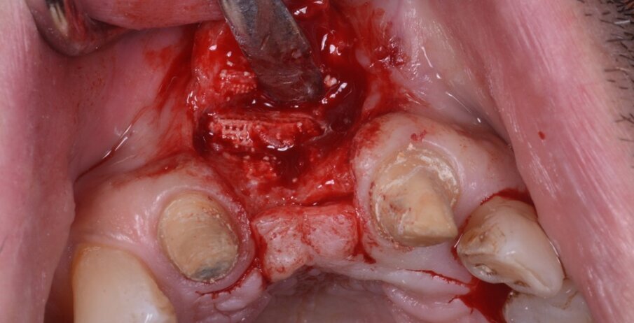 Fig. 15_Sollevamento di lembo mucoperiosteo (spessore totale): si evidenzia la rigenerazione ottenuta con il blocco onlay di idrossiapatite che è fermamente adeso all’osso nativo. L’integrazione del blocco è evidente clinicamente.