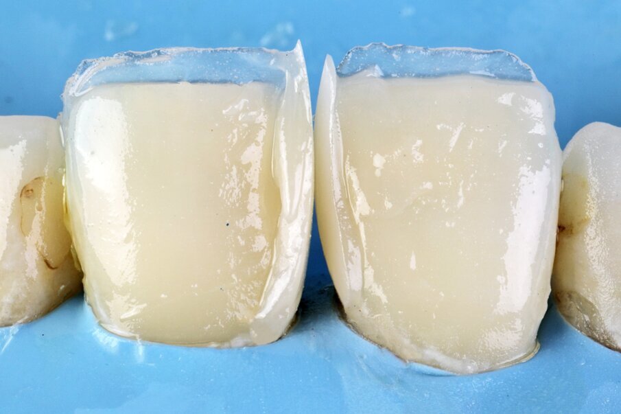 Fig. 8: Build-up of proximal area and establishing contact with Beautifil II Enamel shade HVT. 