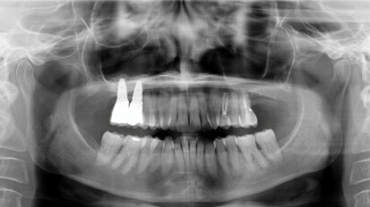 Sinus lift surgery in severely resorbed  maxillae: One-year follow-up