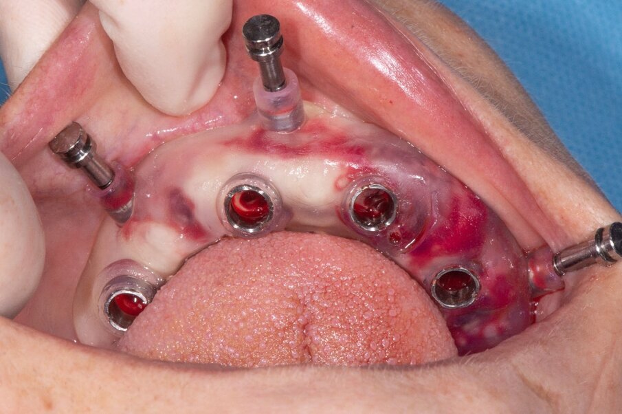 Fig. 7_Fissaggio dima inferiore.
