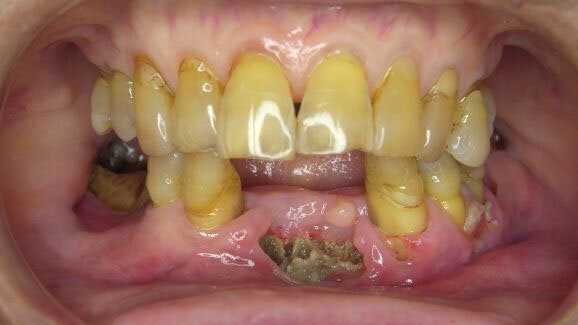 Bisfosfonaten verhogen risico op osteonecrose in kaak