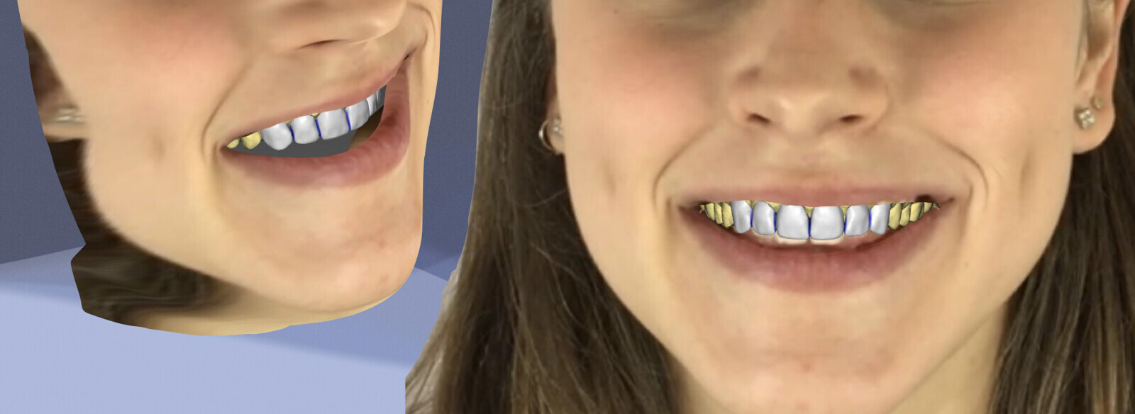 Fig. 9 : Smile design dans inLab CAD SW 22.0 (Dentsply Sirona).