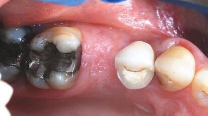 Alveolaire Ridge Preservation