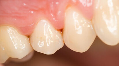 Patiënten met tandplaque overlijden eerder door kanker