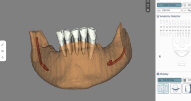Изкуствен интелект и обогатена реалност при планиране на имплантологични лечения