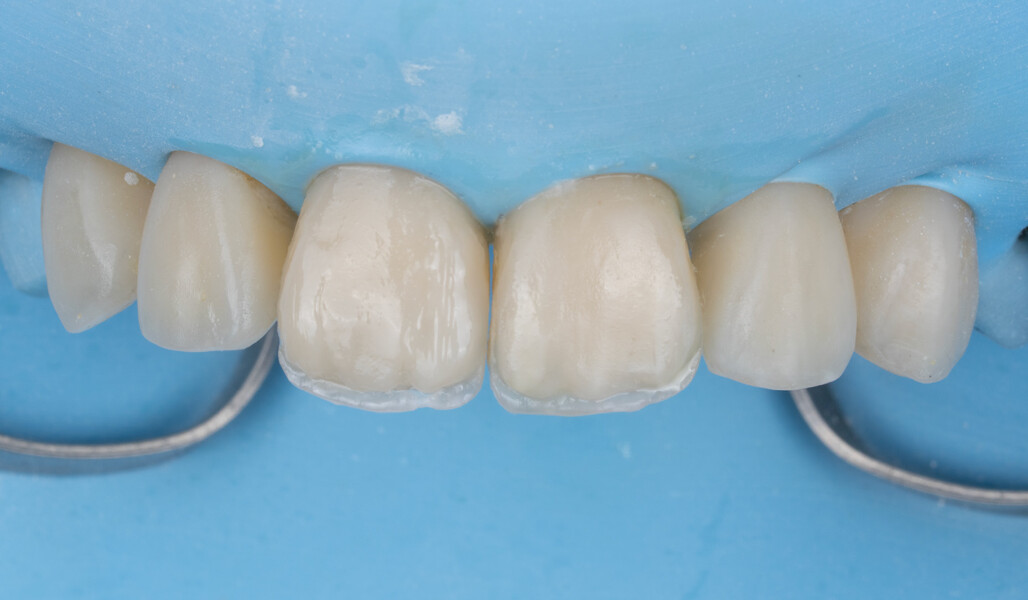 Fig. 7: Modification of the central incisor restorations.