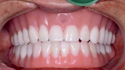 L’apport des solutions CFAO aux restaurations complètes sur implants