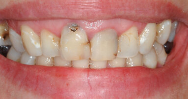 Approccio interdisciplinare paro-protesico di una riabilitazione in area estetica