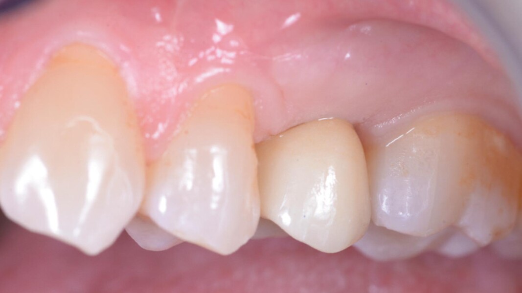 Fig. 8_Corona definitiva.