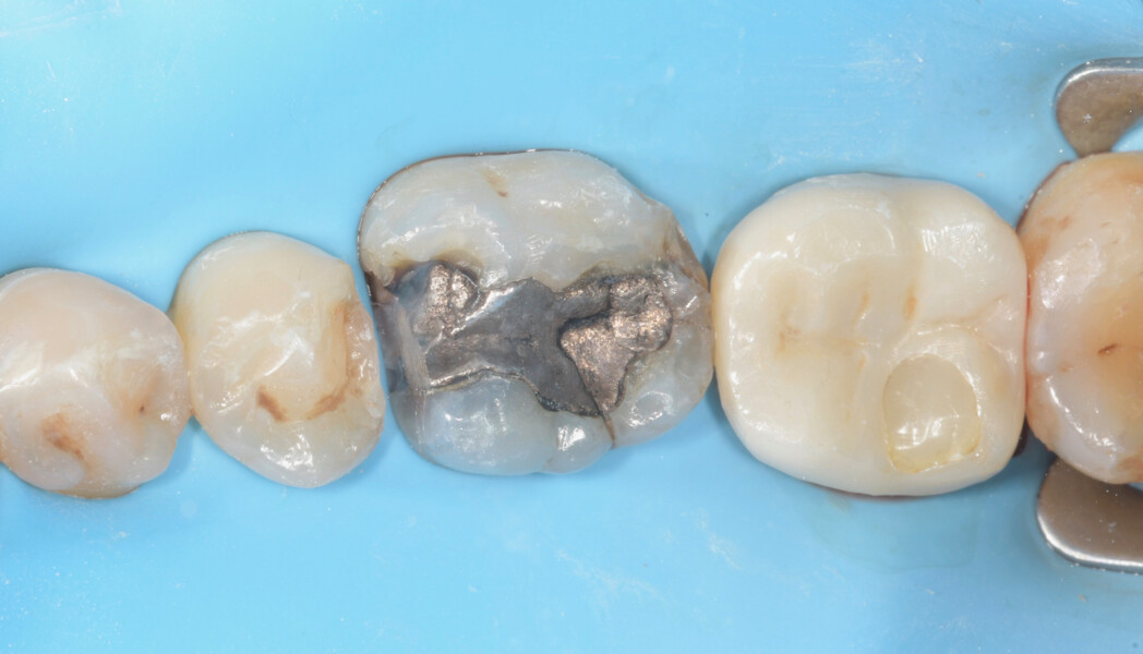 Fig. 16: Isolation of the mandibular left quadrant with a dental dam before removal of the old restoration.