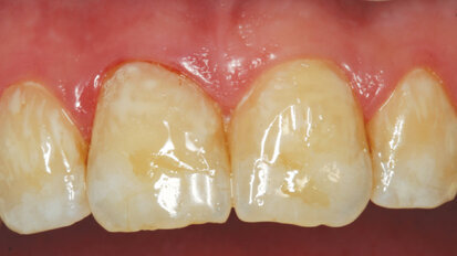 Caries removal and esthetic direct composite restorations