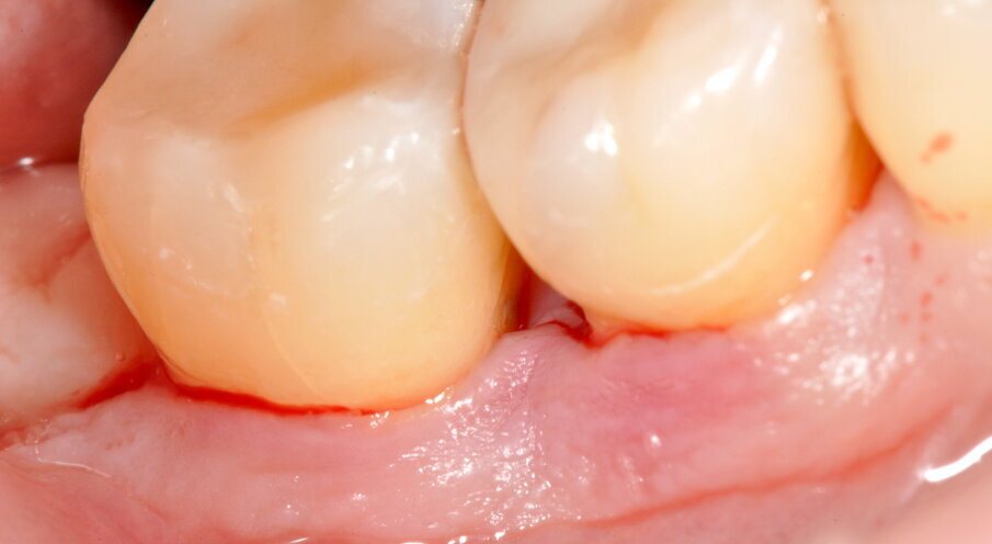 Fig. 7 - Disegno del lembo con preservazione della papilla interdentale.