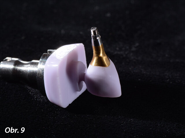 Viditelné ideální spojení abutmentu a korunky.