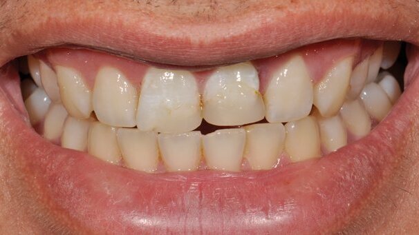 Trattamento biomimetico grazie a una scala colori intelligente modificabile in un caso post-trauma