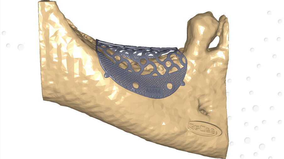 Figg. 2a, 2b_Modello digitale con il progetto definitivo della griglia in titanio customizzata Yxoss CBR protect.