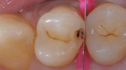 Restauri diretti in composito con le nuove matrici V4-Ring Micerium