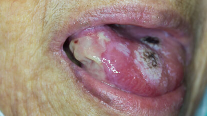 New guidance for care of patients with oral potentially malignant disorders