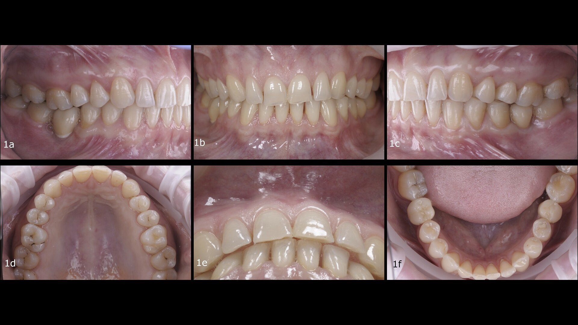 Interdisciplinary treatment of an adult patient with worn anterior teeth