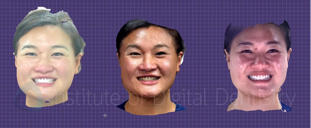 From left: Facial scans obtained with MetiSmile, Qlone and RAYFace.