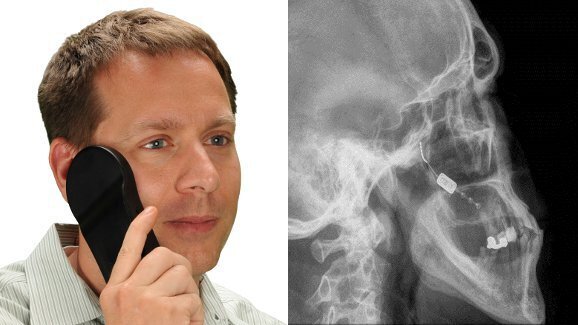 Neurostimulacija: Gingivalni implantat pomaže smanjenju cluster glavobolje