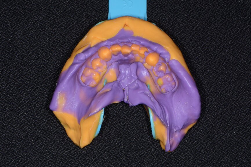 Fig. 8: Mandibular impression (Kettenbach).