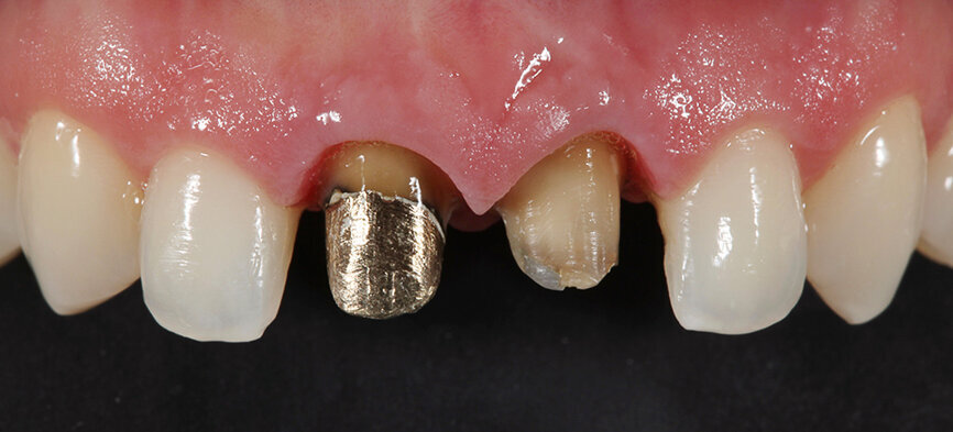 Fig. 5. Dado que el diente 11 había sido sometido a una reconstrucción de perno-muñón metálica, se optó por utilizar estructuras de aleación no preciosa.