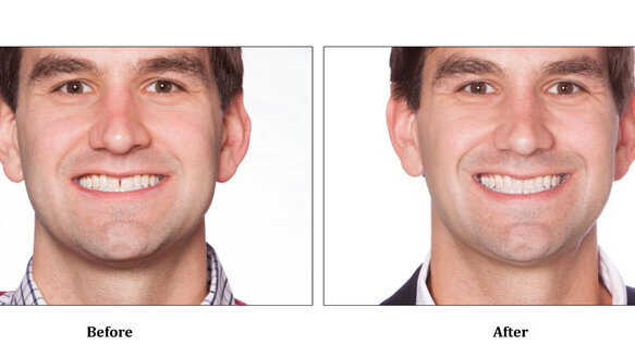 Company offers patients ‘do-it-at-home’ orthodontics