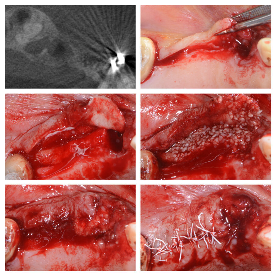Fig. 2a_Tecnica S.A.T. applicata in zona 23-24-25.