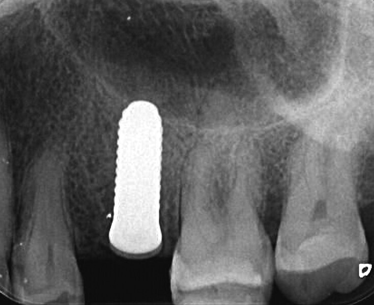Fig. 23 : Radiographie montrant l’intégration tissulaire parfaitement réussie après deux mois. 