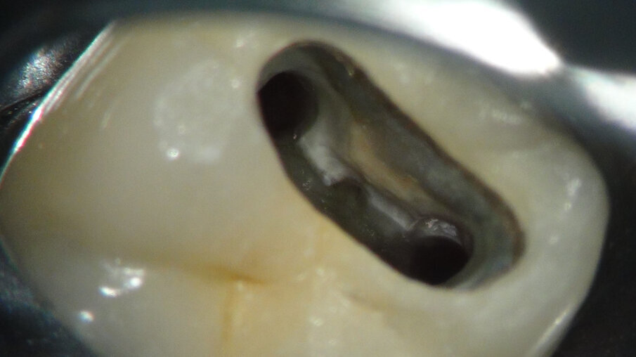 Afbeelding 13. Het is belangrijk geduldig te blijven en de oplosmiddelen voor guttapercha in te laten werken en te activeren.
