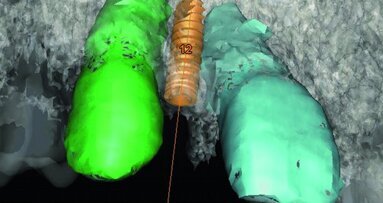 Implants de faible diamètre pour des édentements unitaires antérieurs