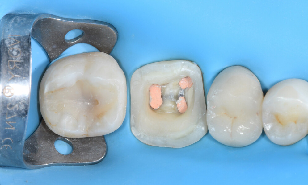 Fig. 7a: Endodontic treatment of tooth #46: after obturation.