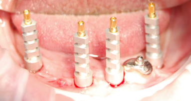 Cyfrowe narzędzia na różnych etapach leczenia implatoprotetycznego bezzębnej żuchwy