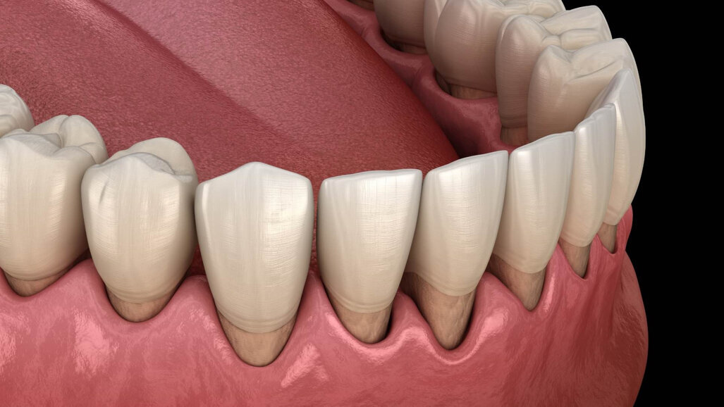 Biomimetička remineralizacija – prevladavanje preosjetljivosti dentina kod parodontalne bolesti