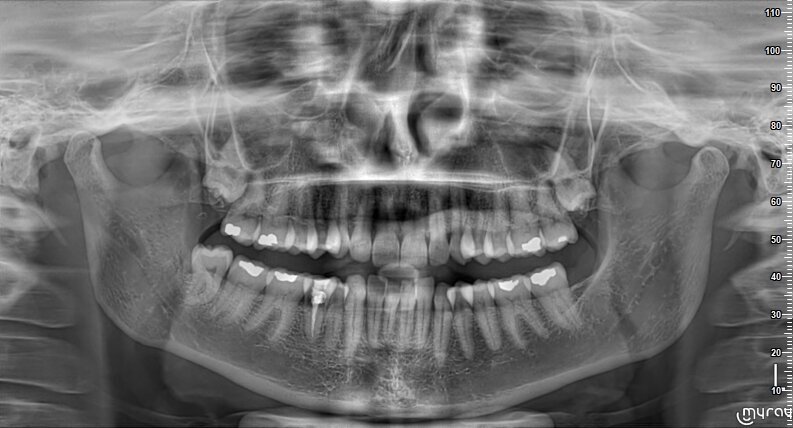 Fig. 1 - Radiografia panoramica della situazione iniziale.