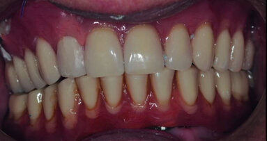 La mise en charge immédiate en implantologie basale