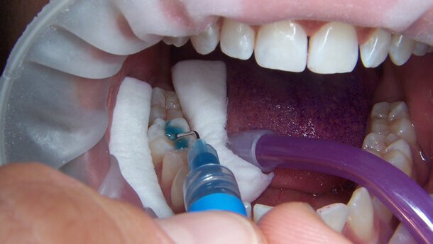 La videocamera intraorale, un valido supporto nella pratica clinica