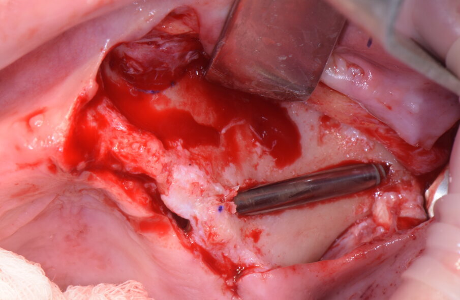 Figg. 20-23 - Impianto zigomatico AoN: notare la posizione extrasinusale con il mantenimento del picco osseo crestale.