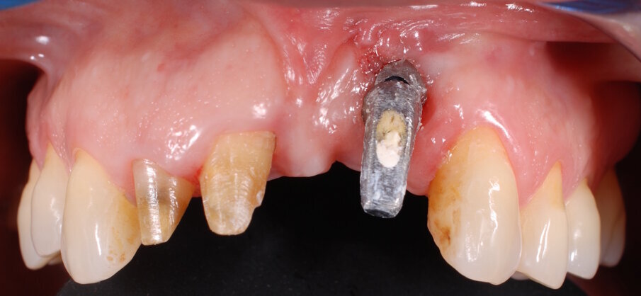 Fig. 3 - Rimozione del manufatto protesico che evidenzia la posizione errata dell’impianto in sede 2.1.