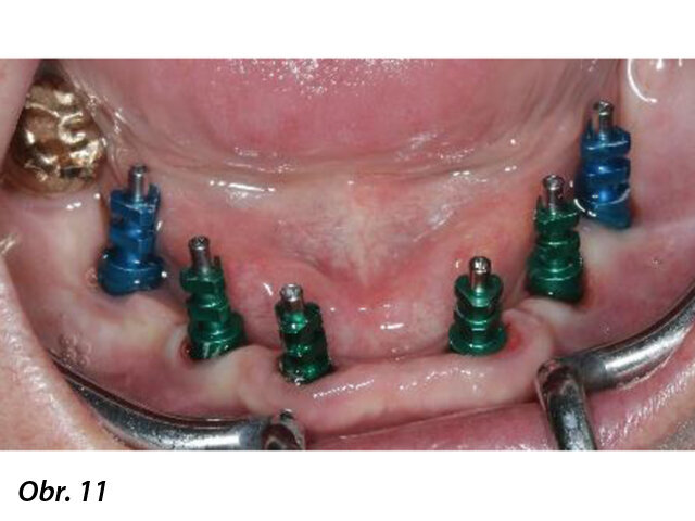 Pohled zpředu na krytky zajištěné šroubky při otiskování 24 týdnů po zavedení implantátů.