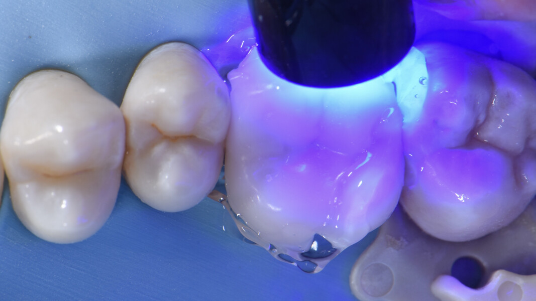 Fig. 28: Thorough light polymerisation of the resin cement.