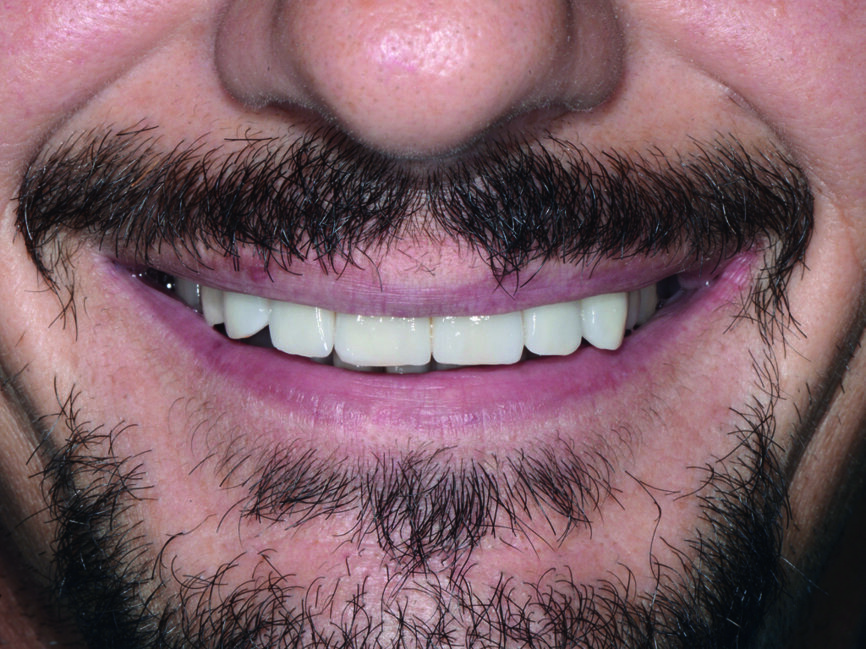 Fig. 24 : Vue extra-orale postopératoire. des incisives centrales supérieures avec protection en PTFE.