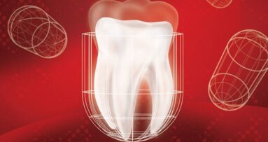 Endo's soms overbodig door vervanger natuurlijk dentine
